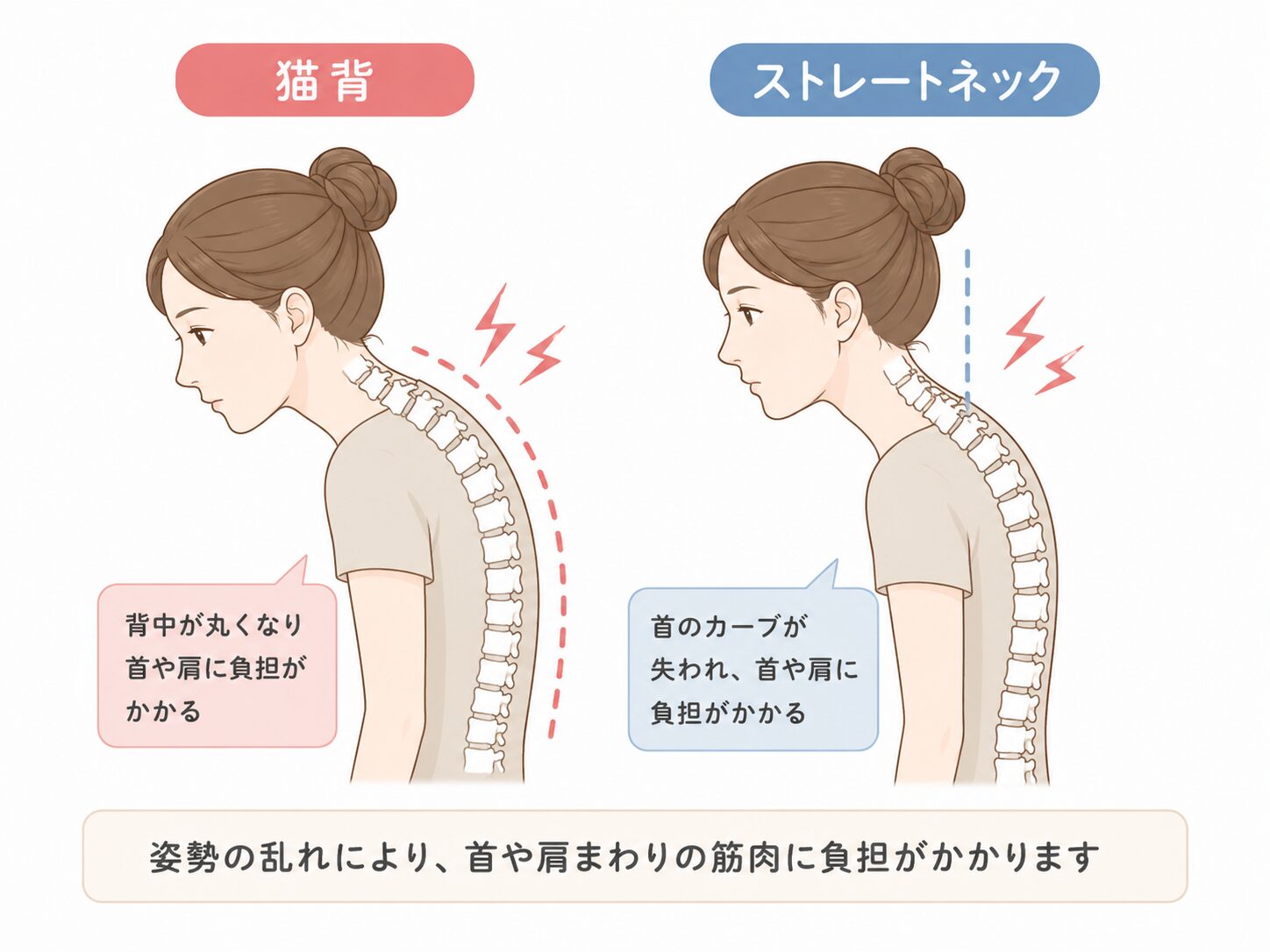 猫背とストレートネックによる首への負担イメージ|草津市